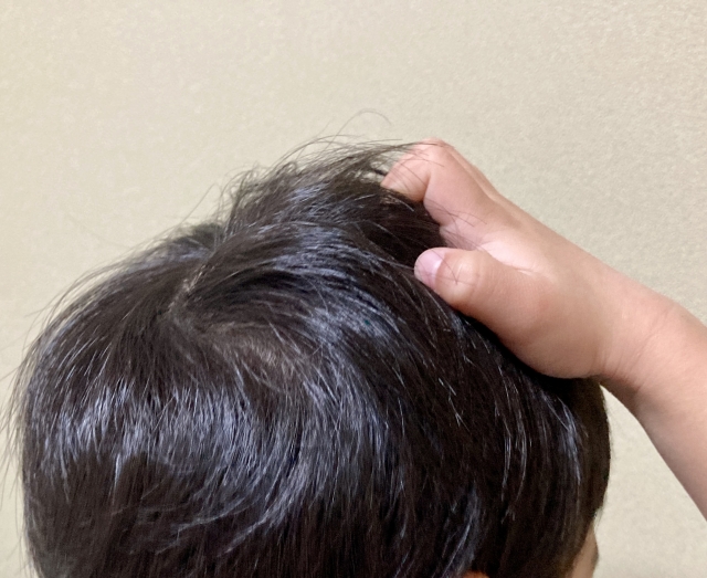 頭皮トラブル