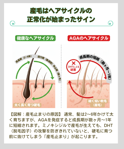 AGAのヘアサイクル：産毛はヘアサイクルの正常化が始まったサイン