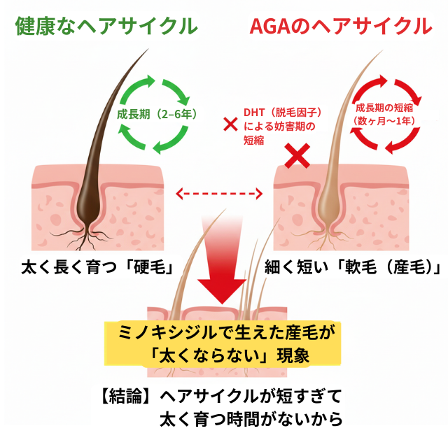 ミノキシジルで産毛は出るのに太くならない